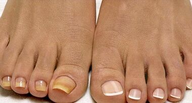 Métodos de tratamento de fungos de flota