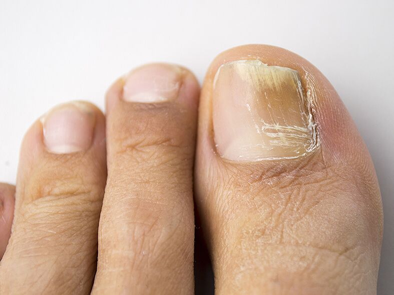 A etapa inicial do fungo